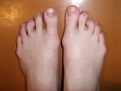 Вальгусная деформация большого пальца ноги