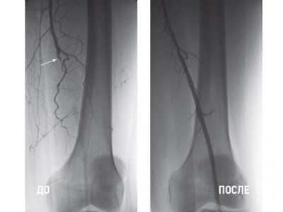 ДО. Окклюзия (непроходимость) левой поверхностной бедренной артерии (стрелка).
<br/>
<br/>
ПОСЛЕ. Проведена чрескожная транслюминальная ангиопластика артерии. Кровоток восстановлен.