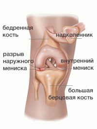 Мениск коленного сустава 